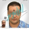 کاشت مو طبیعی با یک میلیون تومان