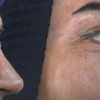 کاشت مو و ابرو با پرداخت 8 تومن و قسطی