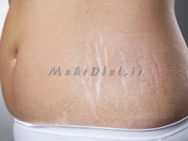 رفع سلولیت با کربوکسی تراپی