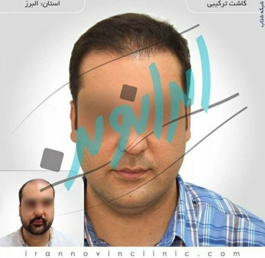 کاشت مو طبیعی با یک میلیون تومان