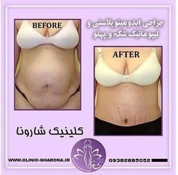 پروتز سینه و لیپوماتیک در شهرک غرب